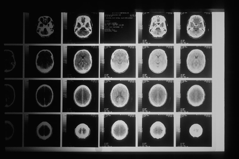 Microplastics Are Breaching the Brain's Last Defense. Tumours May Be the Proof.