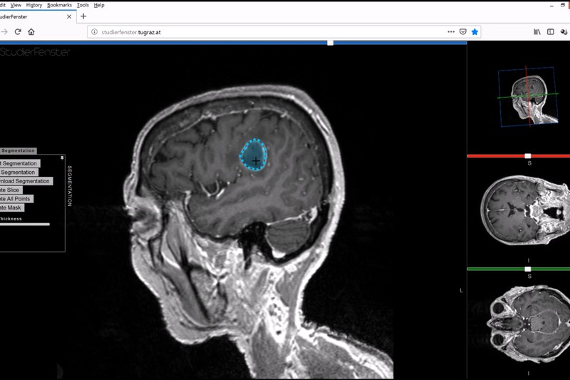 Gene Therapy Saved a Boy. His Tumor Carried Its Signature.