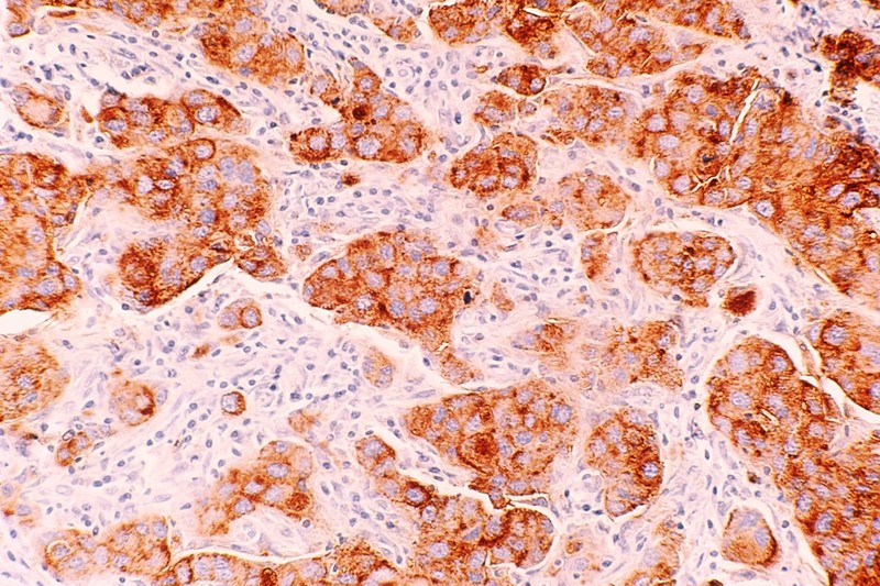 A Daily Pill, Twice the Time: Pancreatic Cancer's First Real Breakthrough in Decades